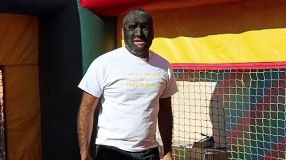 مرد گرگی که ۹۸ درصد بدنش را مو پوشانده است + عکس