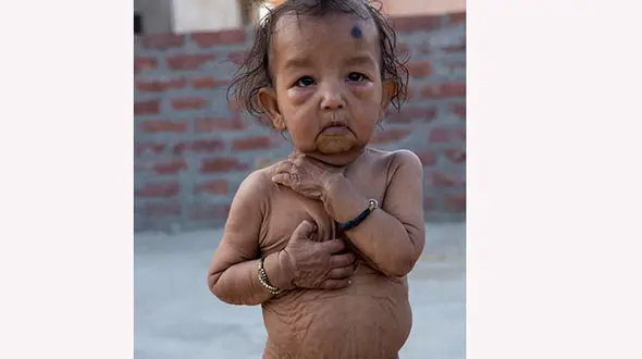 این دوکودک پیر به دنیا آمدند + عکس