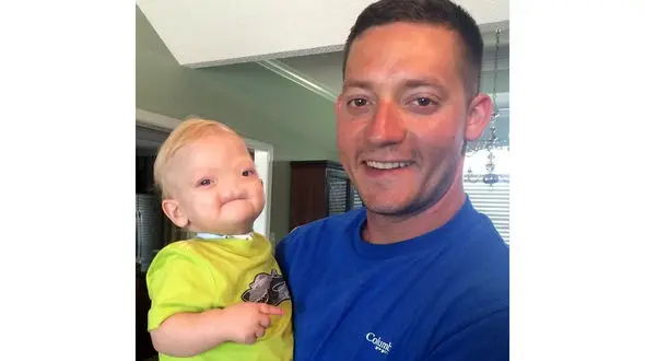 پسر بچه بدون دماغ 2 سال خندید و تسلیم مرگ شد+عکس 