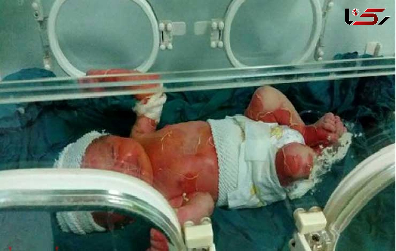 پرونده سوختگی نوزاد سه روزه در انتظار نظر پزشکی قانونی