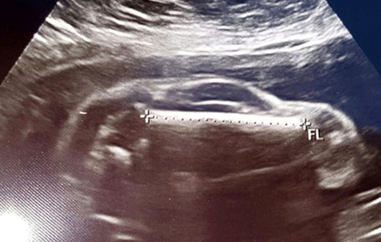 ماشین اسپرت در شکم یک زن حامله ! + عکس سونوگرافی