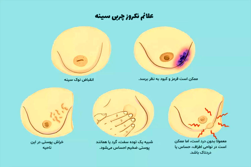 کیست سینه