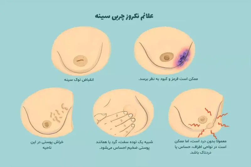 کیست سینه