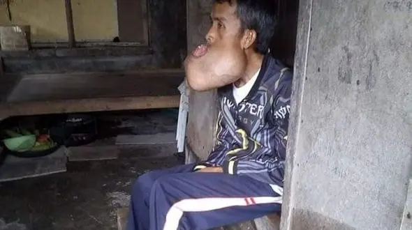 
توموری عجیب در دهان این مرد / اگر طلاقتش را ندارید این عکس ها را نبینید
