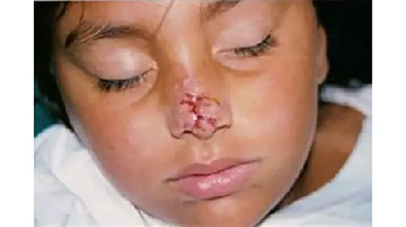 گاز گرفتن و کندن دماغ دختر جوان در درگیری وحشیانه دو خواهر ! / در میشیگان اتفاق افتاد+عکس