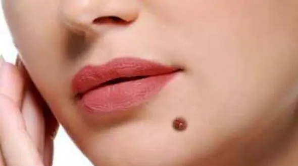 نکاتی که باید قبل از برداشتن خال بدانید +تصاویر