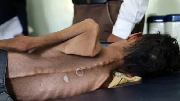 استخوان های این کودک از بدنش بیرون زده است + عکس
