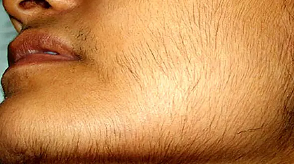 پرمویی غیر طبیعی در زنان + علت