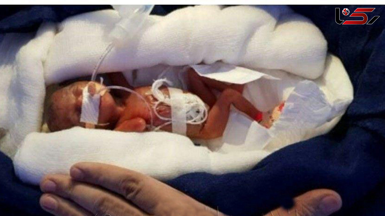 عکسی عجیب از نوزادی که نباید زنده می ماند! + برترین عکس