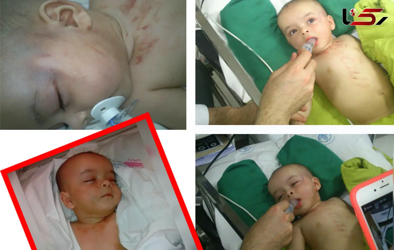 عکس های دلخراش از آزار نوزاد 5 ماهه در رشت / پرونده در دادسر تحت رسیدگی است+تصاویر