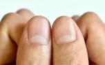 قرمزی هلال ناخن نشانه چیست؟ از بیماری‌ های قلبی تا اختلالات خودایمنی