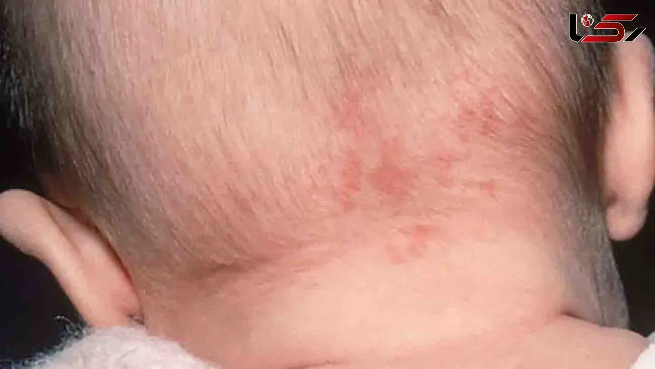 علت ماه گرفتگی پوستی چیست؟ / صفر تا صد ماه گرفتگی