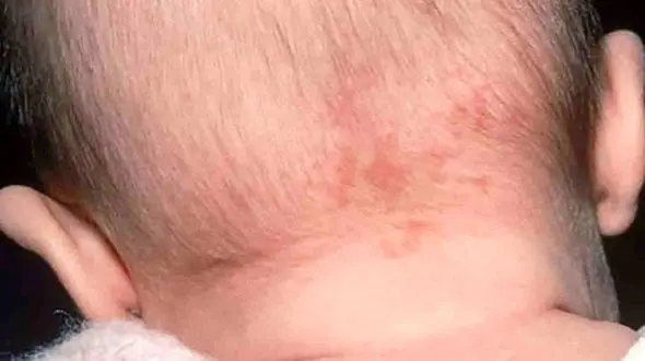 علت ماه گرفتگی پوستی چیست؟ / صفر تا صد ماه گرفتگی