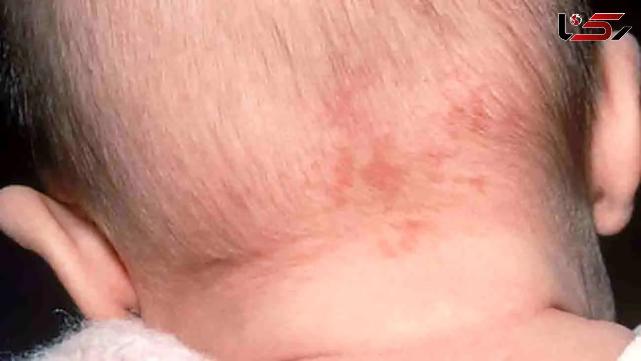 علت ماه گرفتگی پوستی چیست؟ / صفر تا صد ماه گرفتگی