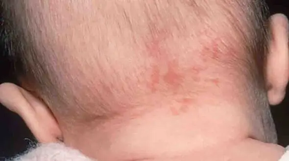 علت ماه گرفتگی پوستی چیست؟ / صفر تا صد ماه گرفتگی