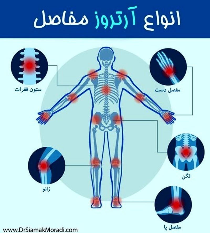 انواع آرتروز