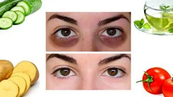 با این خوراکی ها از شر تیرگی زیر چشم خلاص شوید