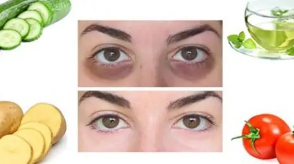 با این خوراکی ها از شر تیرگی زیر چشم خلاص شوید