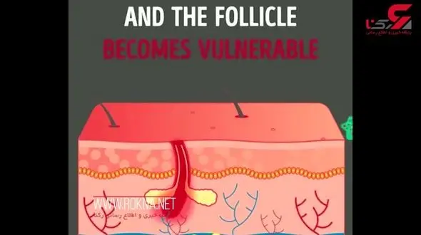 کندن موی بینی و خطر مرگ دارد ! + فیلم