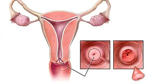 تفسیر تست های سرطان رحم