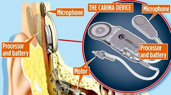 بازیابی شنوایی با ایمپلنت گوش بیونیک