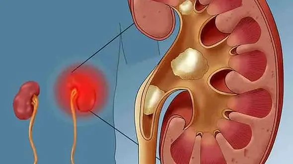 اگر کلیه شن ساز دارید این دمنوش را بخورید