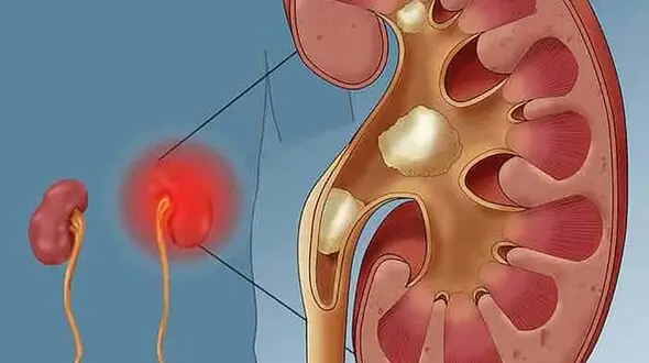 اگر کلیه شن ساز دارید این دمنوش را بخورید