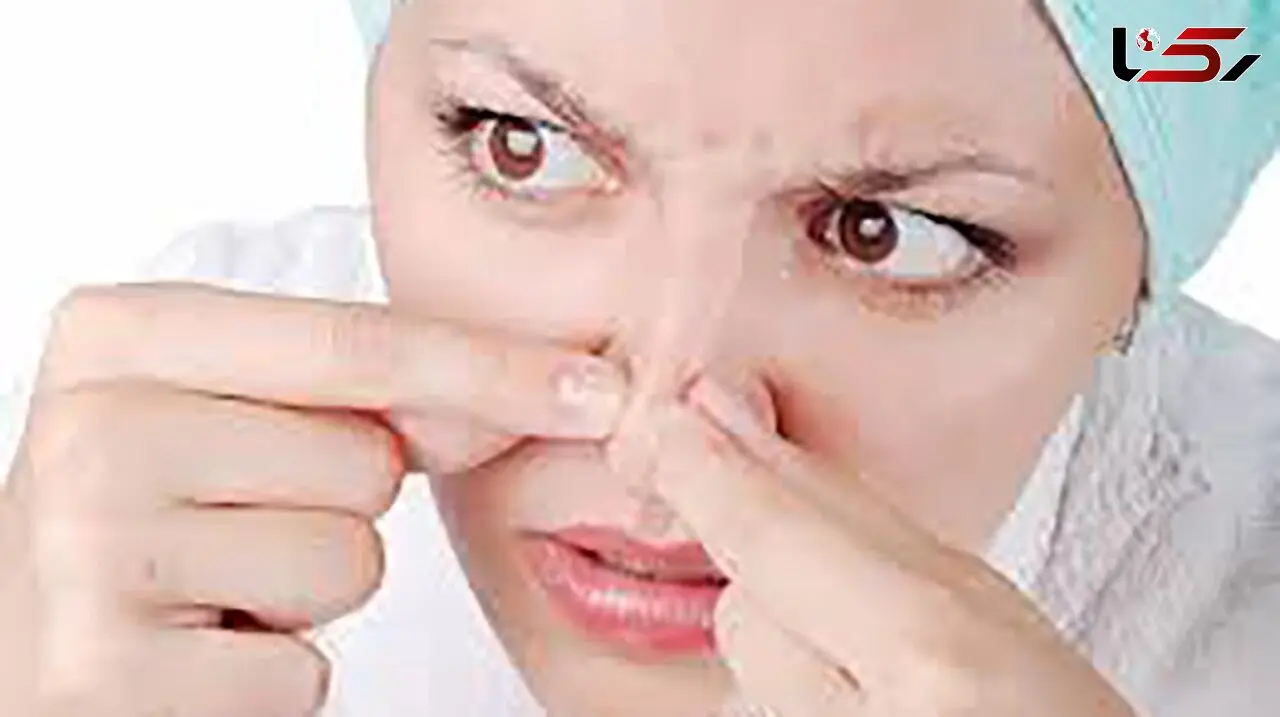 نابودی جوش‌ های سرسیاه با این خوراکی ها