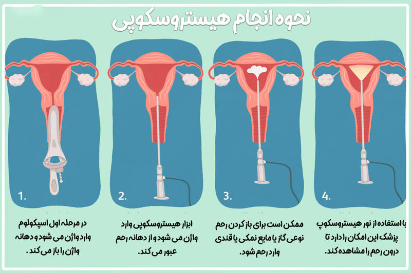 نحوه انجام هیستروسکوپی