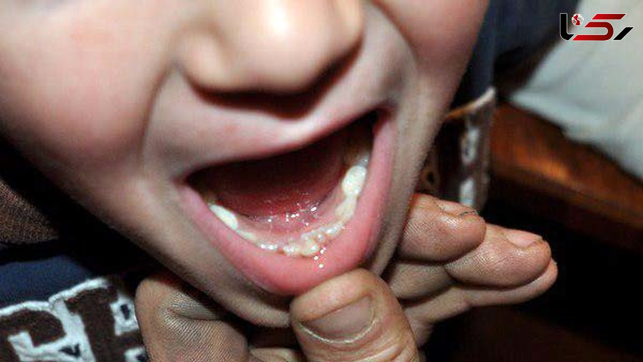 پوشش 154 هزار دانش‌آموز ابتدایی استان همدان در طرح وارنیش فلورایدتراپی دندان
