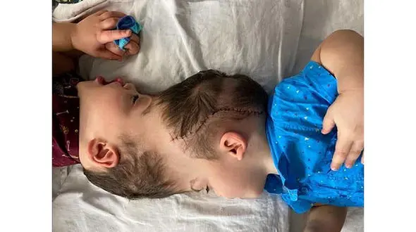 فیلم /  ماجرای جداسازی دوقلوهای به‌هم‌ چسبیده برزیلی