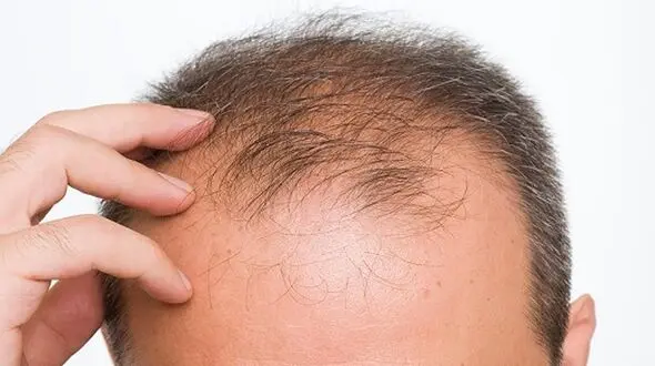 چرا ریزش مو در مردان شایع تر است؟/روش های درمانی مفید