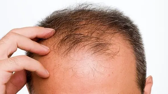 چرا ریزش مو در مردان شایع تر است؟/روش های درمانی مفید
