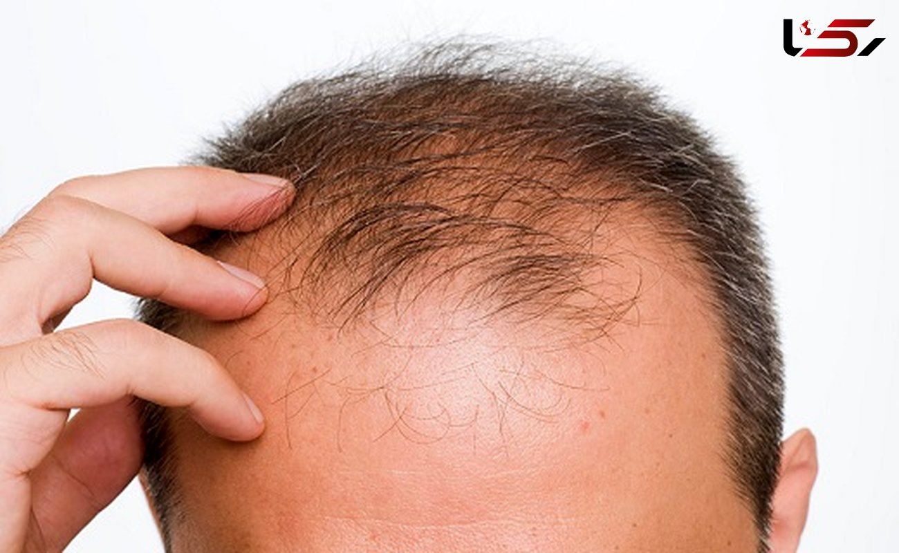 چرا ریزش مو در مردان شایع تر است؟/روش های درمانی مفید