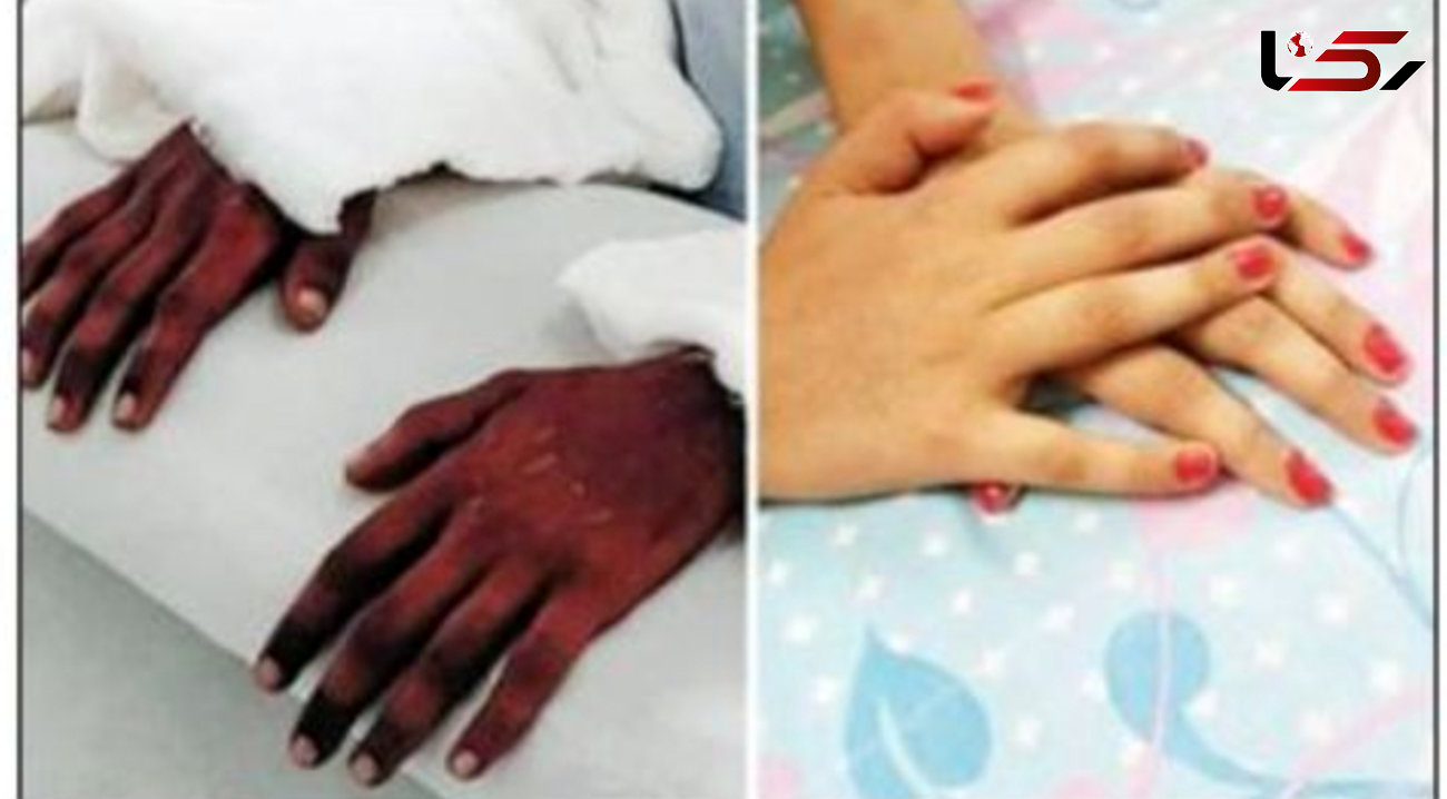 تغییر رنگ عجیب دست‌های پیوندی زن جوان ! + عکس