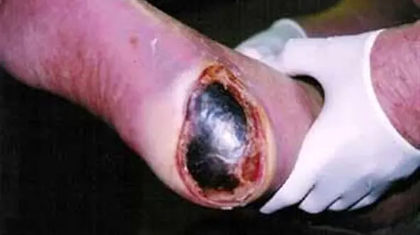 زخم‌های خطرناک تر  از سرطان‌