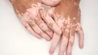 این قرص نجات بخش رنگ پوست مبتلایا ن پیسی است