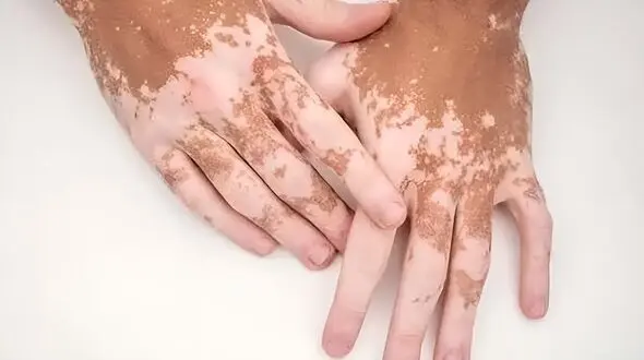 این قرص نجات بخش رنگ پوست مبتلایا ن پیسی است