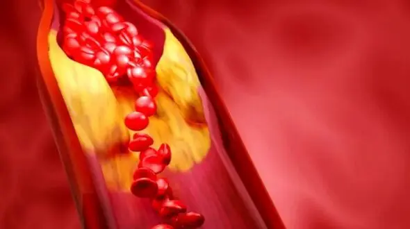 چگونه کلسترول و تری‌ گلیسیرید بالا را مدیریت کنیم؟