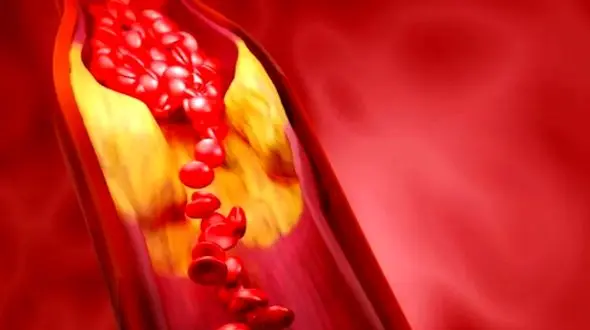 چگونه کلسترول و تری‌ گلیسیرید بالا را مدیریت کنیم؟