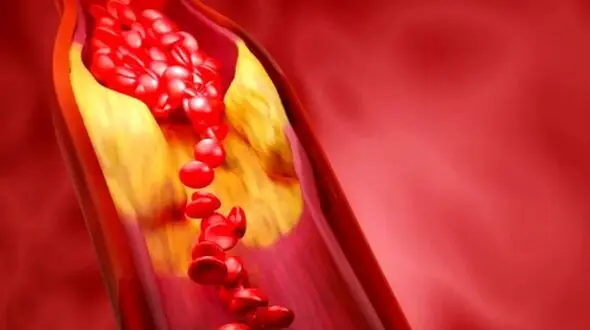 چگونه کلسترول و تری‌ گلیسیرید بالا را مدیریت کنیم؟