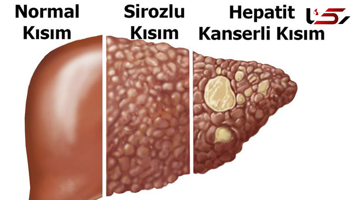 نشانه های کبد چرب چیست؟