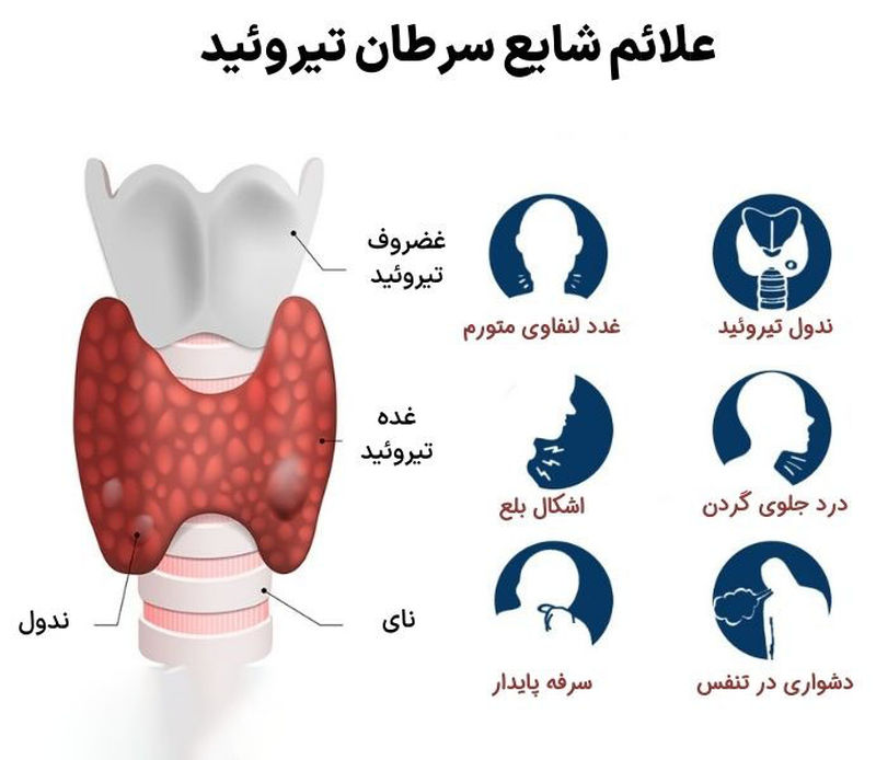 علائم سرطان تیروئید