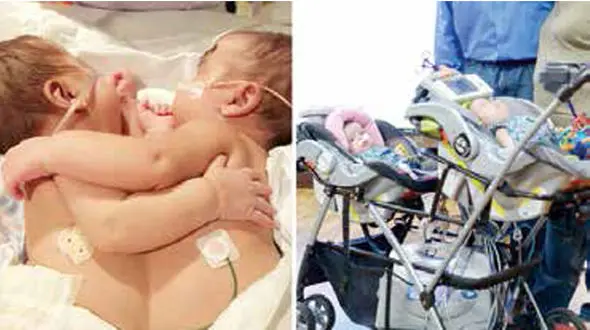 11 ساعت جراحی برای جدایی دوقلوها +عکس