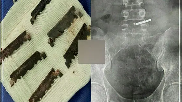 خودکشی فجیع با خوردن چند عدد تیغ توسط جوان خوزستانی + عکس