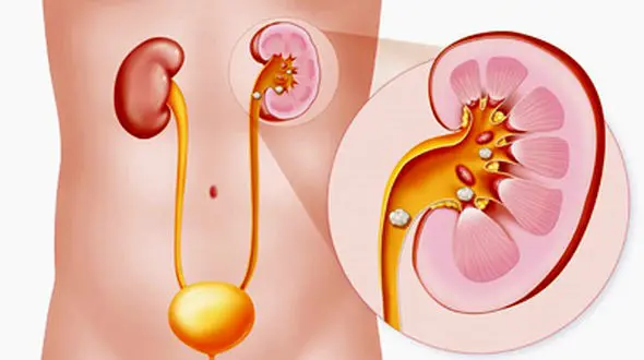 10 عامل اصلی ابتلای به سنگ کلیه