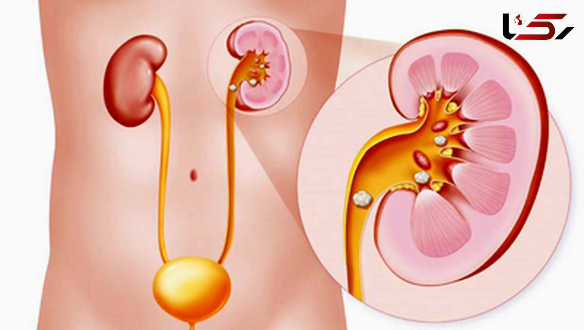 10 عامل اصلی ابتلای به سنگ کلیه