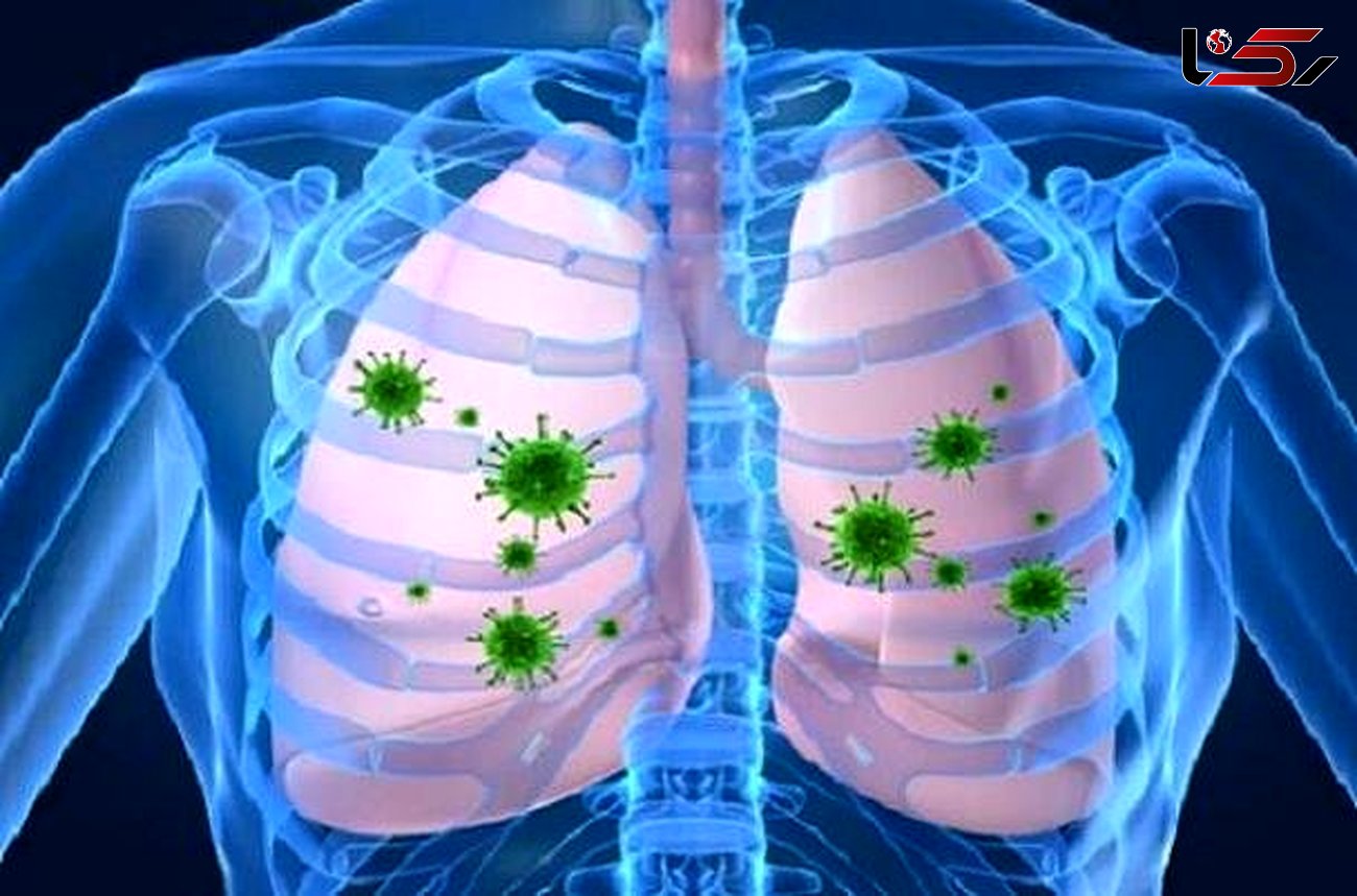 رایج ترین علائم عفونت ریه را بشناسید