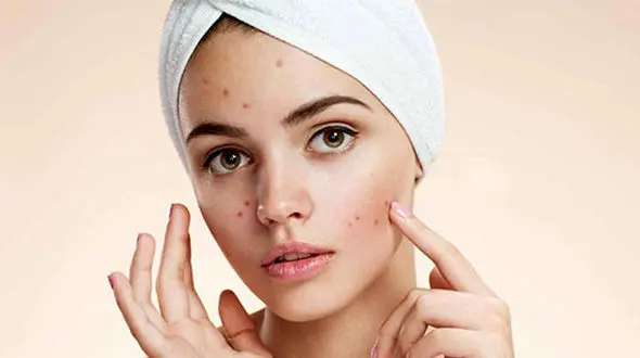 درمان جوش صورت با طلایی ترین راهکارها