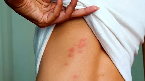  درمان جوش های پشت بدن با ترفندهای طلایی